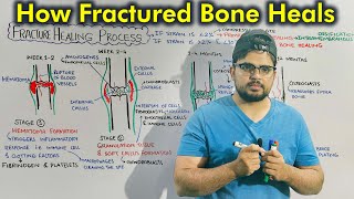 Fractures Causes Signs and Symptoms Diagnosis and Treatment [upl. by Emelen67]