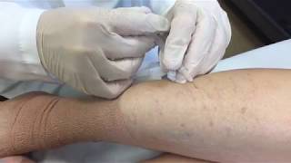 Varicose Vein Treatment  George Anton MD [upl. by Seabury]