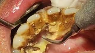 How to remove TARTAR from Teeth  Tartar removal before and after [upl. by Elbart]