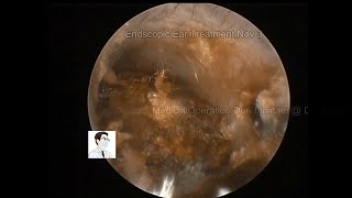 Review of cholesteatoma and ear wax removal9mins20221103 [upl. by Cleodel]