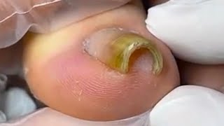 curly toenails need a good treatment [upl. by Tanny]