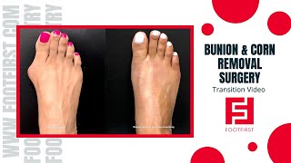 Bunion and Corn Removal Surgery Results Check it Out [upl. by Ahsimed798]