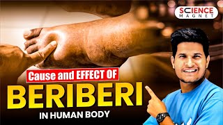 Railway Exams 202425 Cause and Effect of Beriberi in human body neerajsir sciencemagnet [upl. by Vod]