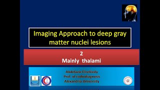 thalamic lesions [upl. by Aisayt]