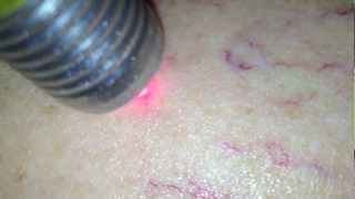 LASER TRANSDERMICO EM TELANGIECTASIAS [upl. by Iover411]