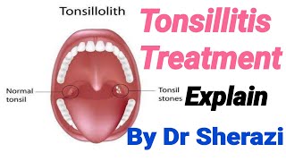 Homeopathic medicine for tonsils Tonsicare homeopathic medicine full explain in hindi urdu [upl. by Idou]