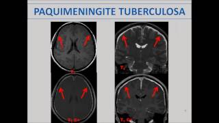 Meningites e Abscessos [upl. by Esta428]