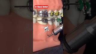 BRACES Orthodontics treatment [upl. by Monda]