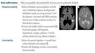 USMLE STEP 1  Neurology  Neural defects Brain malformation [upl. by Yhtimit]