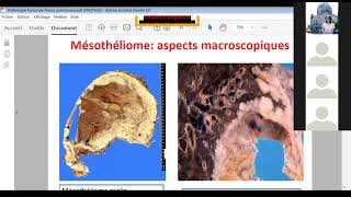 1112Pathologie Tumorale Cancer bronchique Mésothéliome Tumeurs médiatisnales  Pneumo [upl. by Yordan]