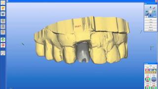 Implant Case 7  Dr Tarun Agarwal Part 2 CEREC impression and crown design [upl. by Arabeila]