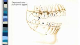 What Happens When a Tooth is Removed [upl. by Eadahc767]