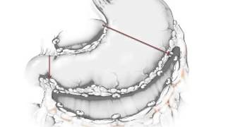 GASTROENTEROLOGIE Complications chirurgicales des ulcères gastroduodénaux 2015 [upl. by Ecirtahs]