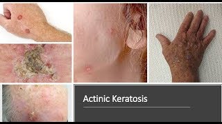 Actinic Kearatosis Solar Keratosis  Causes Diagnosis Symptoms Treatment Prognosis [upl. by Jestude]