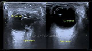 Microphthalmia with persistent primary vitreous [upl. by Trula138]