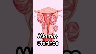 ¡Alerta Síntomas de Miomas uterinos  Dr William Guerrero medicina shorts [upl. by Sosanna]