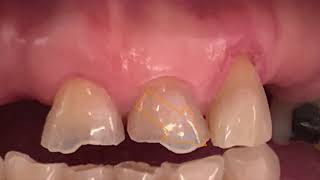 Occlusal trauma and dental mobility Grade 2 [upl. by Ikuy]