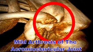 Mild Arthrosis Of The Acromioclavicular Joint [upl. by Llerrahs]