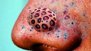 Blackheads Blackhead Removal and Trypophobia Disease [upl. by Livia]