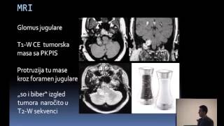 Glomus tumori glave i vrata dijagnostika i endovaskularni tretman Aleksandar Jovanoviski [upl. by Lolly972]