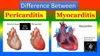 Difference between Pericarditis and Myocarditis [upl. by Aitnuahs]