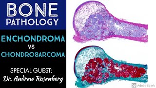 Chondrosarcoma vs Enchondroma Bone Pathology with Dr Andrew Rosenberg [upl. by Epps6]