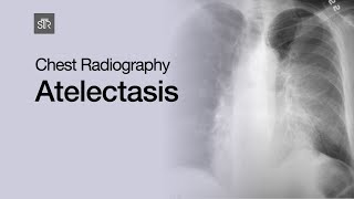 Chest Radiography Atelectasis [upl. by Jody801]