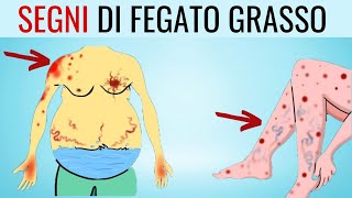 MINACCIA SILENZIOSA 8 SEGNI che POSSONO indicare una malattia del FEGATO GRASSO [upl. by Olinad]