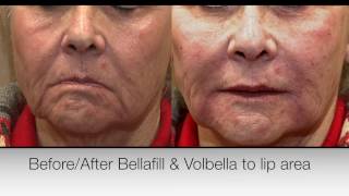 Volbella Injection For Lip Augmentation  Enhancement [upl. by Chretien513]