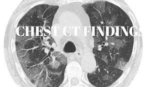 CHEST CT FINDINGS  HRCT CHEST  CECT CHEST  CHEST CT SCAN [upl. by Docilu]