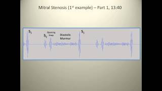 Examples of mitral stenosis murmurs [upl. by Farrah]