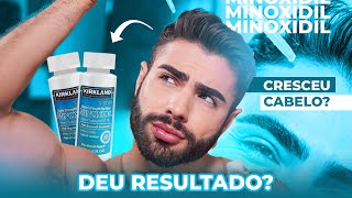 3 meses USANDO o MINOXIDIL  EXPERIÊNCIA REAL [upl. by Tai]