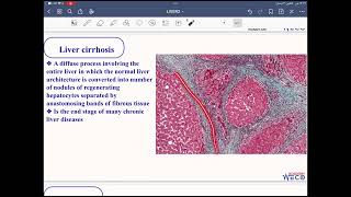 Pathology Hepatobiliary system 2 [upl. by Anirehs]