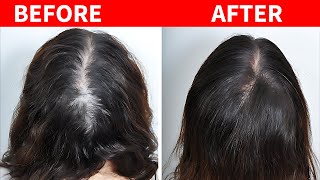 12 Proven Remedies to Prevent Hair Loss and Promote Hair Regrowth [upl. by Ydarg645]