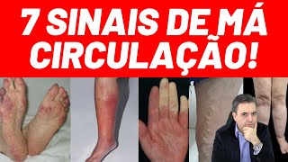 7 sinais de MÁ CIRCULAÇÃO  Fique alerta aos sinais  Dr Alex Vascular [upl. by Cecily]