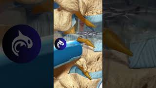 See how a TLIF relieves back pain and restores spinal stability with a 3D Animation [upl. by Vanya]