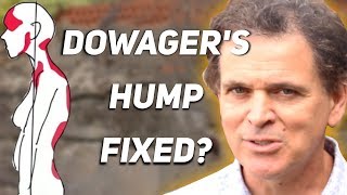 How To Fix Dowagers Hump [upl. by Manuel]