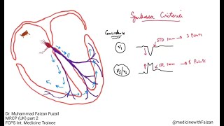 How to diagnose myocardial infarction in LBBB – Sgarbossa Criteria [upl. by Ahsienat850]