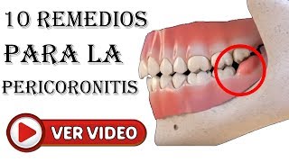 PERICORONITIS 10 Remedios Caseros Para El Dolor Y El Malestar [upl. by Pinette]