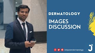 DERMATOLOGY IMAGES DISCUSSION  PART 1  FMGE  NEET PG  DrJazeer Dermatology [upl. by Grindle]