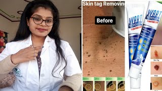 Wart Remover Ointment Wart Remover honest review  Wart Remover Cream benefits uses review in hindi [upl. by Nnaeoj]