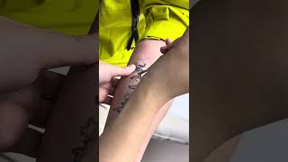 450ps True Picosecond Laser Tattoo Removal [upl. by Frissell439]