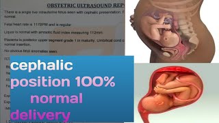 cephalic presentation during pregnancy normal delivery cesarean delivery viralvideo [upl. by Wright580]