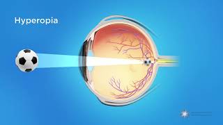 What is Hyperopia Farsightedness [upl. by Dinsdale945]