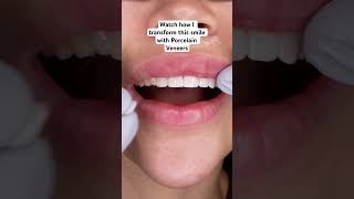 Porcelain veneer smile transformation orthodontist dentaltransformation dentalrestoration [upl. by Neiviv118]