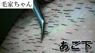 Facial hair removal with tweezers 1 剃りづらい部分を毛抜き ピンセット [upl. by Eolc655]