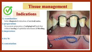 Tissue Management Gingival Retraction Indications amp Requirements دواعي ابعاد اللثة ومتطلباتها [upl. by Attiuqal]