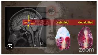 Decalcification of pineal gland and its activation [upl. by Bertila606]