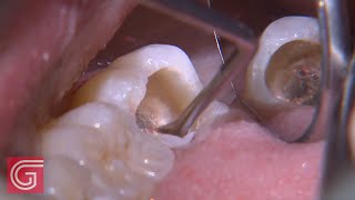 HOW TO Clean Up Severe Occlusal Decay on TOOTH 31 1 of 2 [upl. by Leeann]