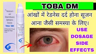 Toba DM eye drop uses in Hindi  Tobramycin and Dexamethasone Opthalmic Solution [upl. by Nnorahs]